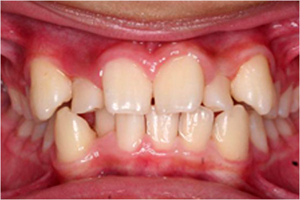 Orthodontics Before 